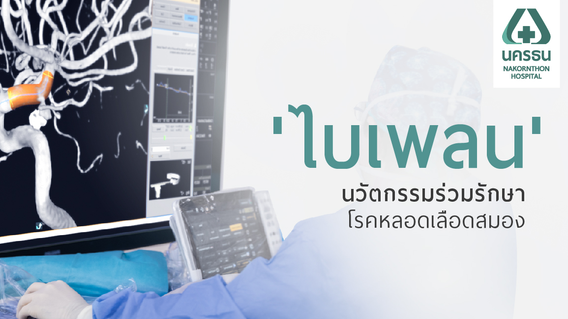 เทคนิคการลากลิ่มเลือด (Clot Retrieval) รักษาผู้ป่วยโรคหลอดเลือดสมองตีบตัน ด้วยเครื่องไบเพลน